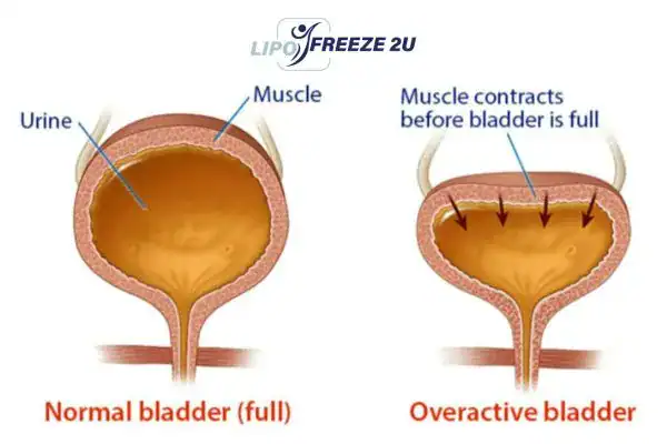diagram of overactive bladder treatment Wakefield
