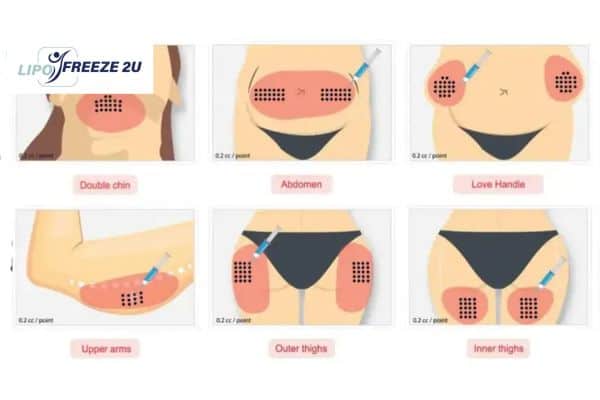 Benefits of Choosing Aqualyx for Fat Reduction Wakefield