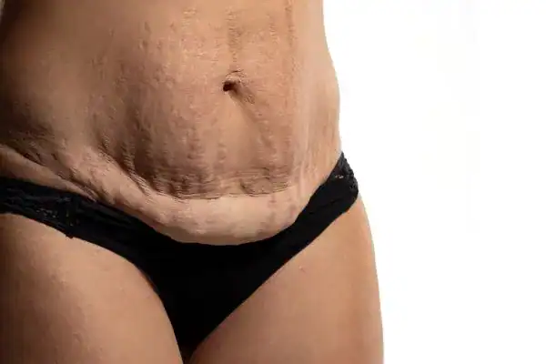 loose skin after weight loss injections Wakefield