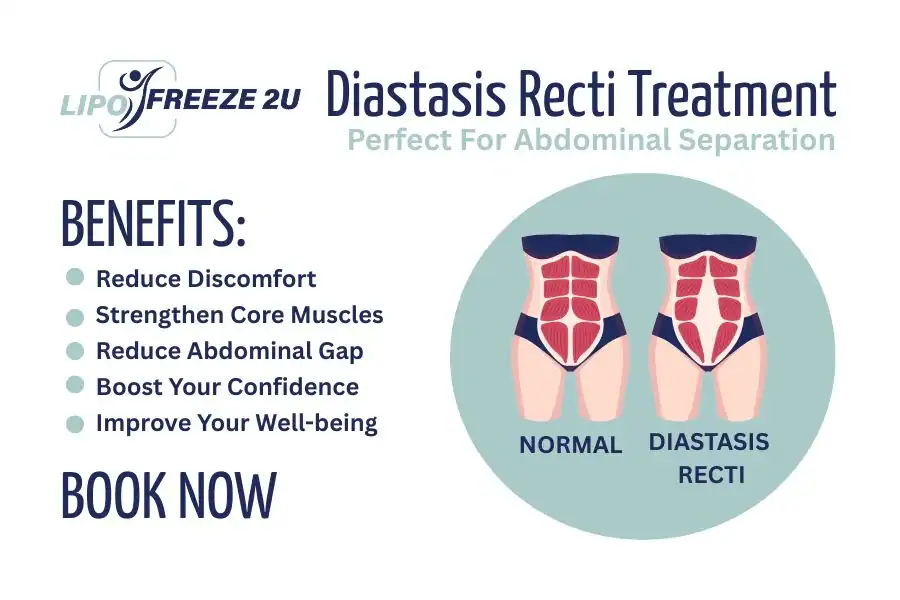 How Long Will It Take to See Improvements in Diastasis Recti Wakefield