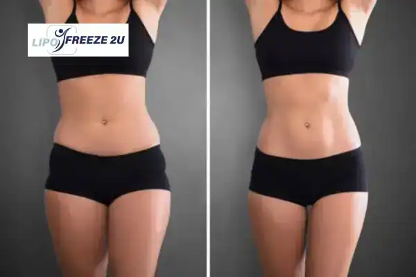 How Can LIPO FREEZE 2U Support Your Post-Pregnancy Body Recovery Wakefield?