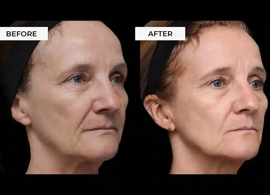 How Many RF Microneedling Sessions Will You Need to See a Difference Wakefield?
