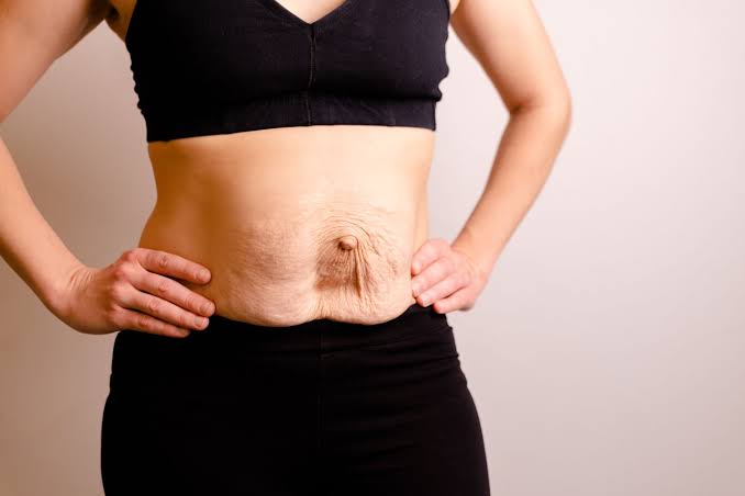 Is Surgery Really the Only Way to Repair Diastasis Recti Wakefield?